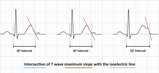 QT interval QT interval